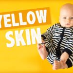 UMMC urges monitoring as jaundice affects many newborns UMMC urges monitoring as jaundice affects many newborns