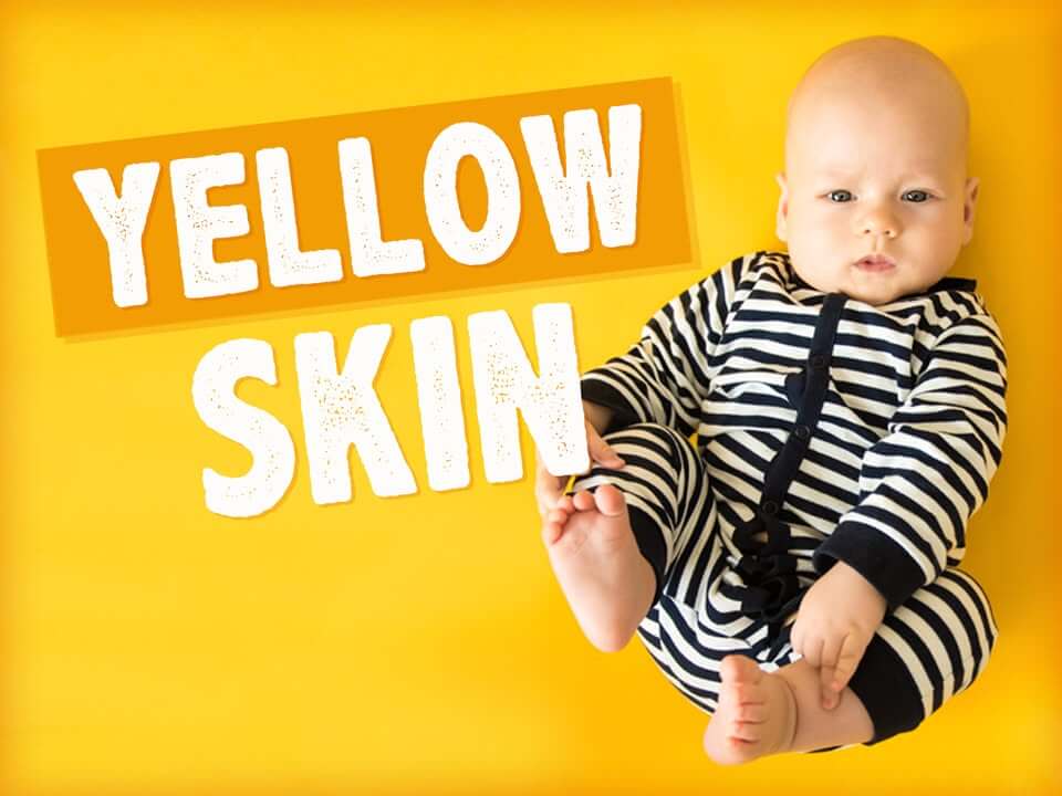 UMMC urges monitoring as jaundice affects many newborns
