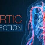Aortic dissection can require immediate recognition and treatment e6c28abd6943df8feb048879